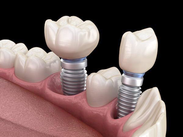 Implantes dentales en Puerto Rico