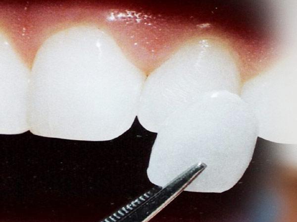 Laminados dentales en Puerto Rico